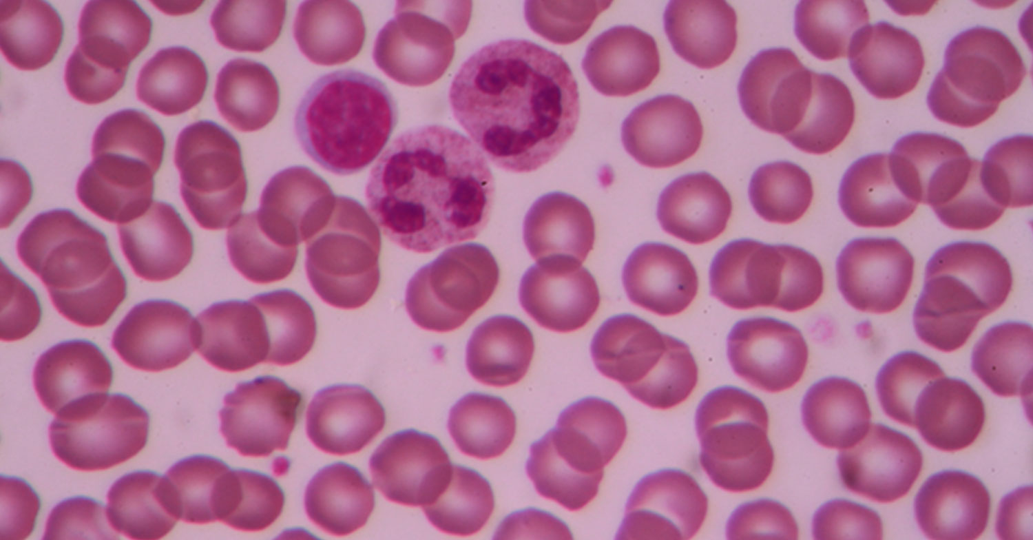 I genitori di una minorenne, affetta da leucemia, condannati per non avere sottoposto la figlia alla chemioterapia.