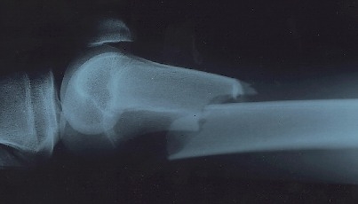 Un uomo ricoverato in ospedale per una patologia renale cade accidentalmente in ...
