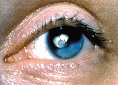 Intervento di cataratta: dopo l'intervento diventa cieca. Responsabilità del med...